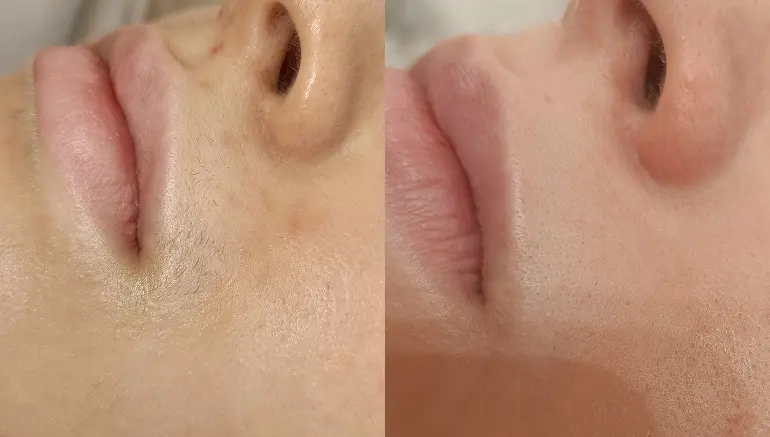 Laser hair removal on the face: before and after — Paphos