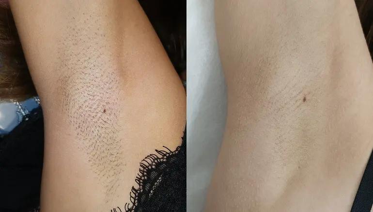 Smooth underarm skin after laser hair removal — Paphos