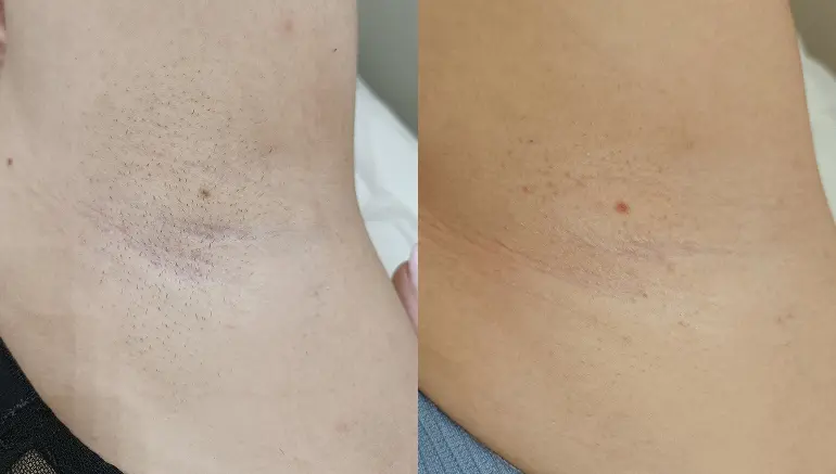Comparison: before and after underarm laser hair removal — Paphos
