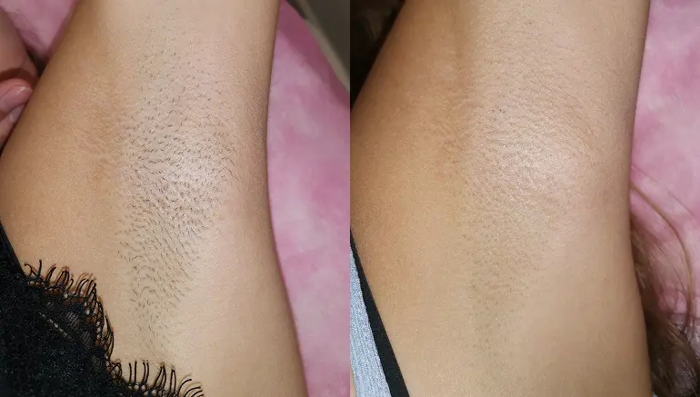 Laser hair removal for underarms: before and after — Paphos