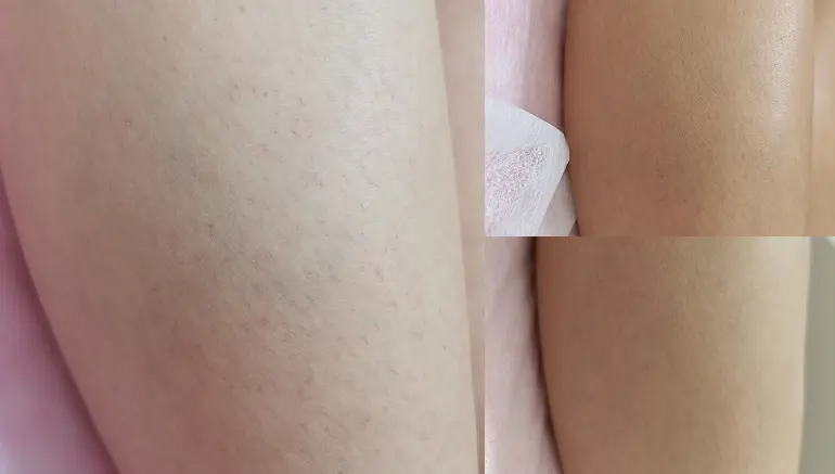 Laser hair removal on legs: before and after photos — Paphos
