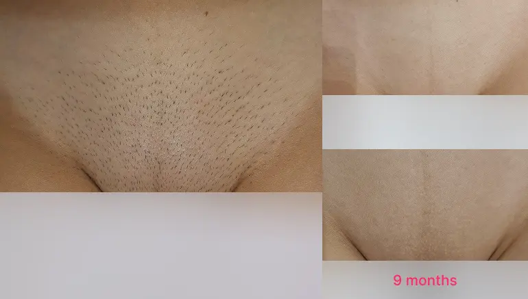 Laser hair removal for bikini: before and after result — Paphos