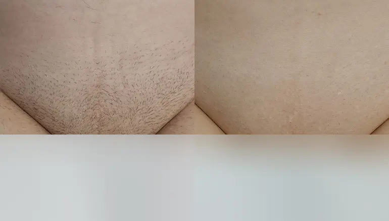 Laser hair removal bikini area: before and after — Paphos