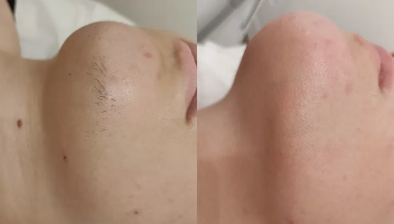 Laser hair removal face result: before and after — Paphos