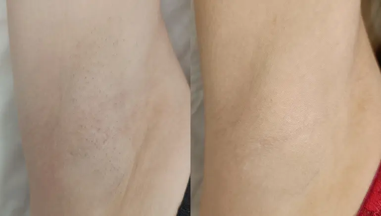 Underarms: before and after laser hair removal — Paphos