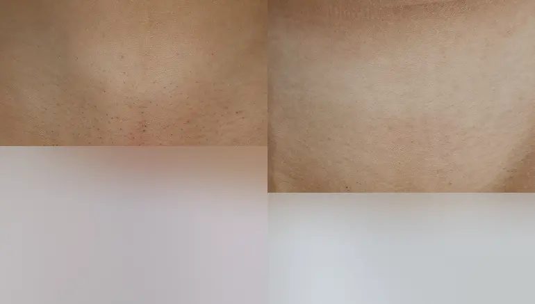 Bikini: laser hair removal result before and after — Paphos