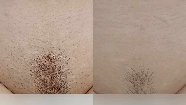 Bikini area after laser hair removal — Paphos
