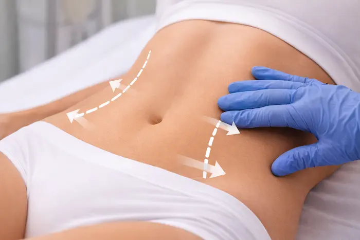 Body contouring treatment for fat reduction on abdomen and thighs