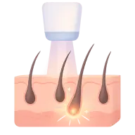 Skin and hair type assessment before laser hair removal