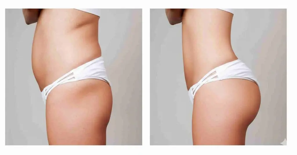 Before and after body contouring results – abdomen treatment